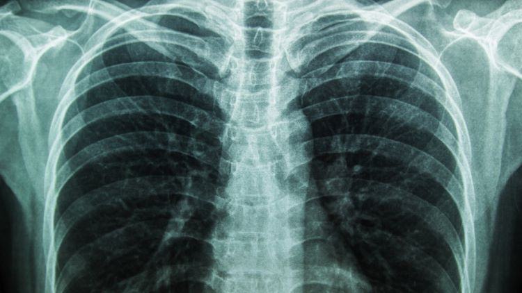 Chest X-ray