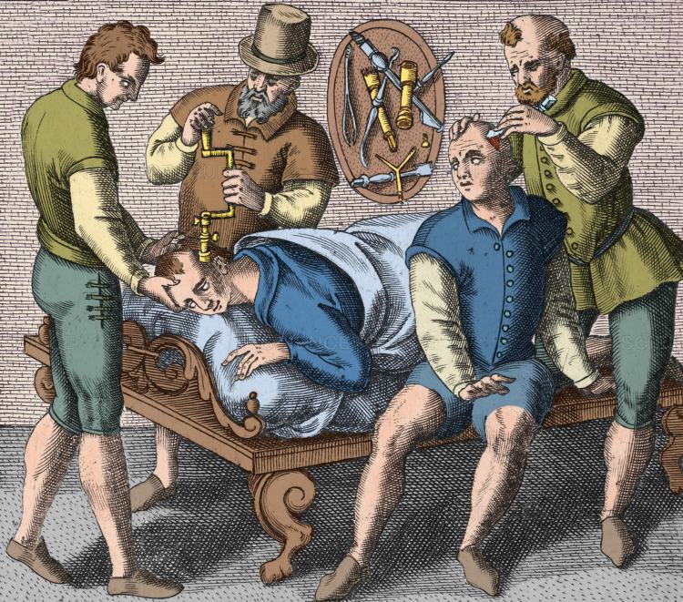 Trepanning